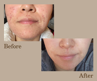 Thylox Acne Treatment Bar Soap